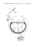 IMPLANT HAVING MULTIPLE ROTATIONAL ASSEMBLIES diagram and image