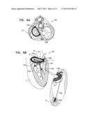 IMPLANT HAVING MULTIPLE ROTATIONAL ASSEMBLIES diagram and image