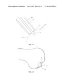 PARTIAL JOINT RESURFACING IMPLANT, INSTRUMENTATION, AND METHOD diagram and image