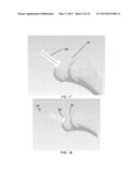 PARTIAL JOINT RESURFACING IMPLANT, INSTRUMENTATION, AND METHOD diagram and image