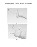 PARTIAL JOINT RESURFACING IMPLANT, INSTRUMENTATION, AND METHOD diagram and image