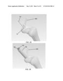 PARTIAL JOINT RESURFACING IMPLANT, INSTRUMENTATION, AND METHOD diagram and image