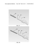 PARTIAL JOINT RESURFACING IMPLANT, INSTRUMENTATION, AND METHOD diagram and image