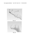 PARTIAL JOINT RESURFACING IMPLANT, INSTRUMENTATION, AND METHOD diagram and image