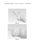 PARTIAL JOINT RESURFACING IMPLANT, INSTRUMENTATION, AND METHOD diagram and image