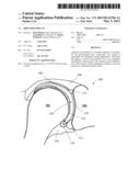 SHOULDER IMPLANT diagram and image