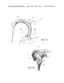 SHOULDER IMPLANT diagram and image