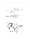 SHOULDER IMPLANT diagram and image