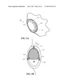 SHOULDER IMPLANT diagram and image