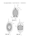 SHOULDER IMPLANT diagram and image