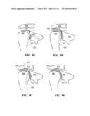 SHOULDER IMPLANT diagram and image