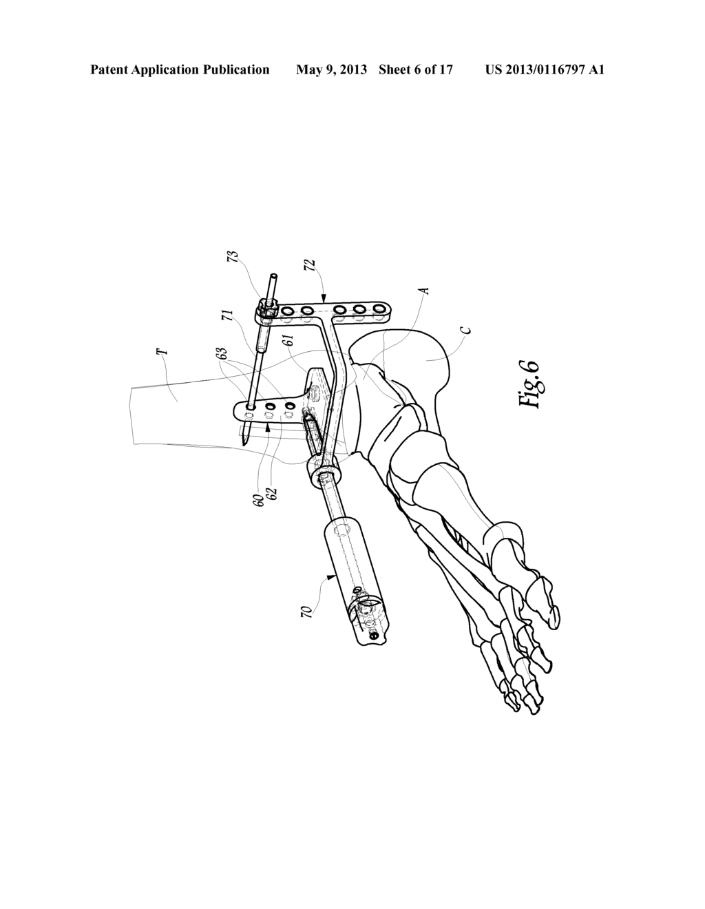 SURGICAL INSTRUMENTATION ASSEMBLY FOR POSITIONING AN ANKLE PROSTHESIS - diagram, schematic, and image 07