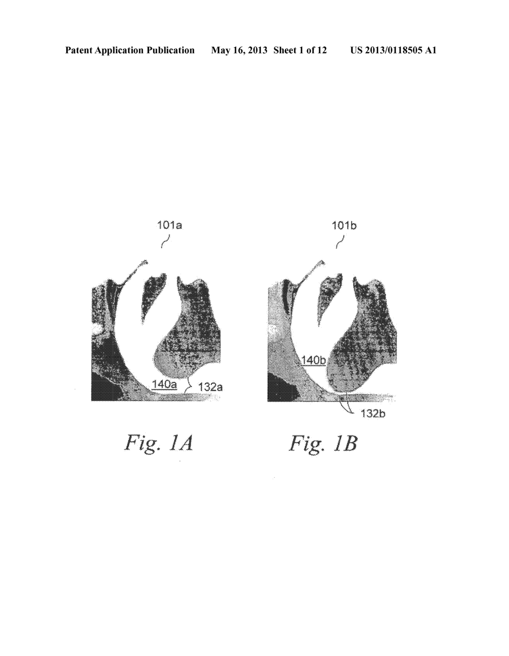 MAGNETIC IMPLANTS AND METHODS FOR TREATING AN OROPHARYNGEAL CONDITION - diagram, schematic, and image 02