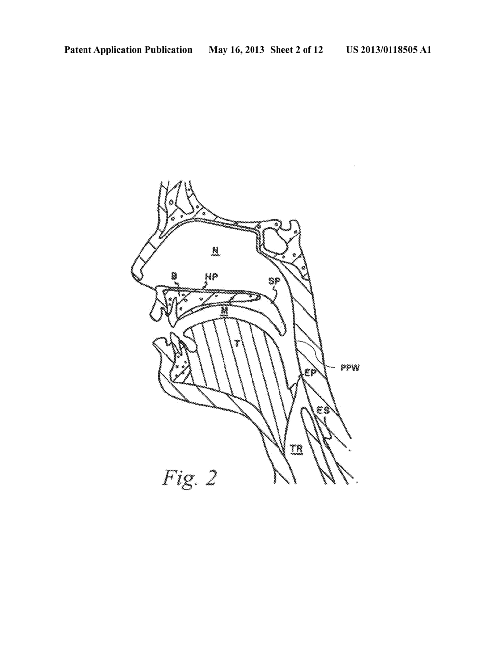 MAGNETIC IMPLANTS AND METHODS FOR TREATING AN OROPHARYNGEAL CONDITION - diagram, schematic, and image 03