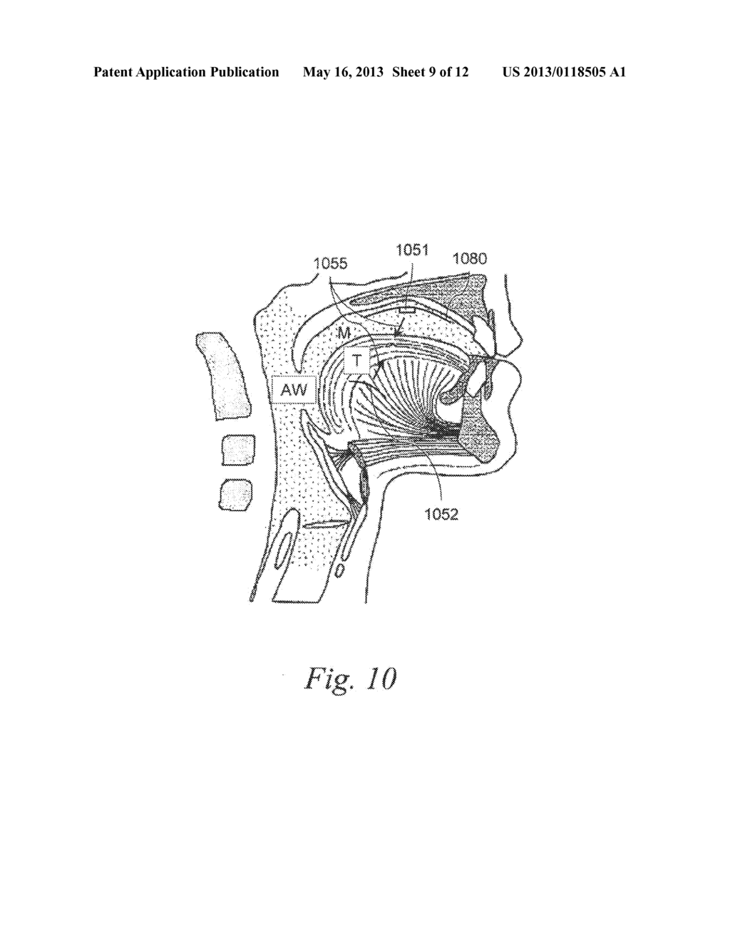MAGNETIC IMPLANTS AND METHODS FOR TREATING AN OROPHARYNGEAL CONDITION - diagram, schematic, and image 10