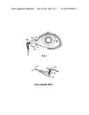 PLUG FOR BLOCKAGE OF THE CANALICULUS diagram and image