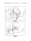 Method of Implant Flossing diagram and image