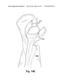 METHOD AND SYSTEM FOR PRODUCING AT LEAST ONE PATIENT-SPECIFIC SURGICAL AID diagram and image