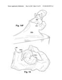 METHOD AND SYSTEM FOR PRODUCING AT LEAST ONE PATIENT-SPECIFIC SURGICAL AID diagram and image