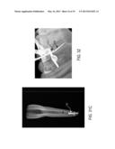 ENDODONTIC OBTURATION SYSTEM AND METHOD diagram and image