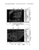 MRI-GUIDED DEVICES AND MRI-GUIDED INTERVENTIONAL SYSTEMS THAT CAN TRACK     AND GENERATE DYNAMIC VISUALIZATIONS OF THE DEVICES IN NEAR REAL TIME diagram and image