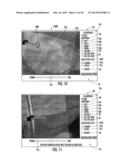 MRI-GUIDED DEVICES AND MRI-GUIDED INTERVENTIONAL SYSTEMS THAT CAN TRACK     AND GENERATE DYNAMIC VISUALIZATIONS OF THE DEVICES IN NEAR REAL TIME diagram and image