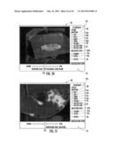 MRI-GUIDED DEVICES AND MRI-GUIDED INTERVENTIONAL SYSTEMS THAT CAN TRACK     AND GENERATE DYNAMIC VISUALIZATIONS OF THE DEVICES IN NEAR REAL TIME diagram and image