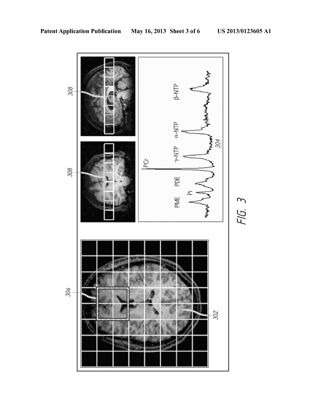 BRAIN PHOSPHORUS SPECTROSCOPY IN BIPOLAR DISORDER - diagram, schematic, and image 04