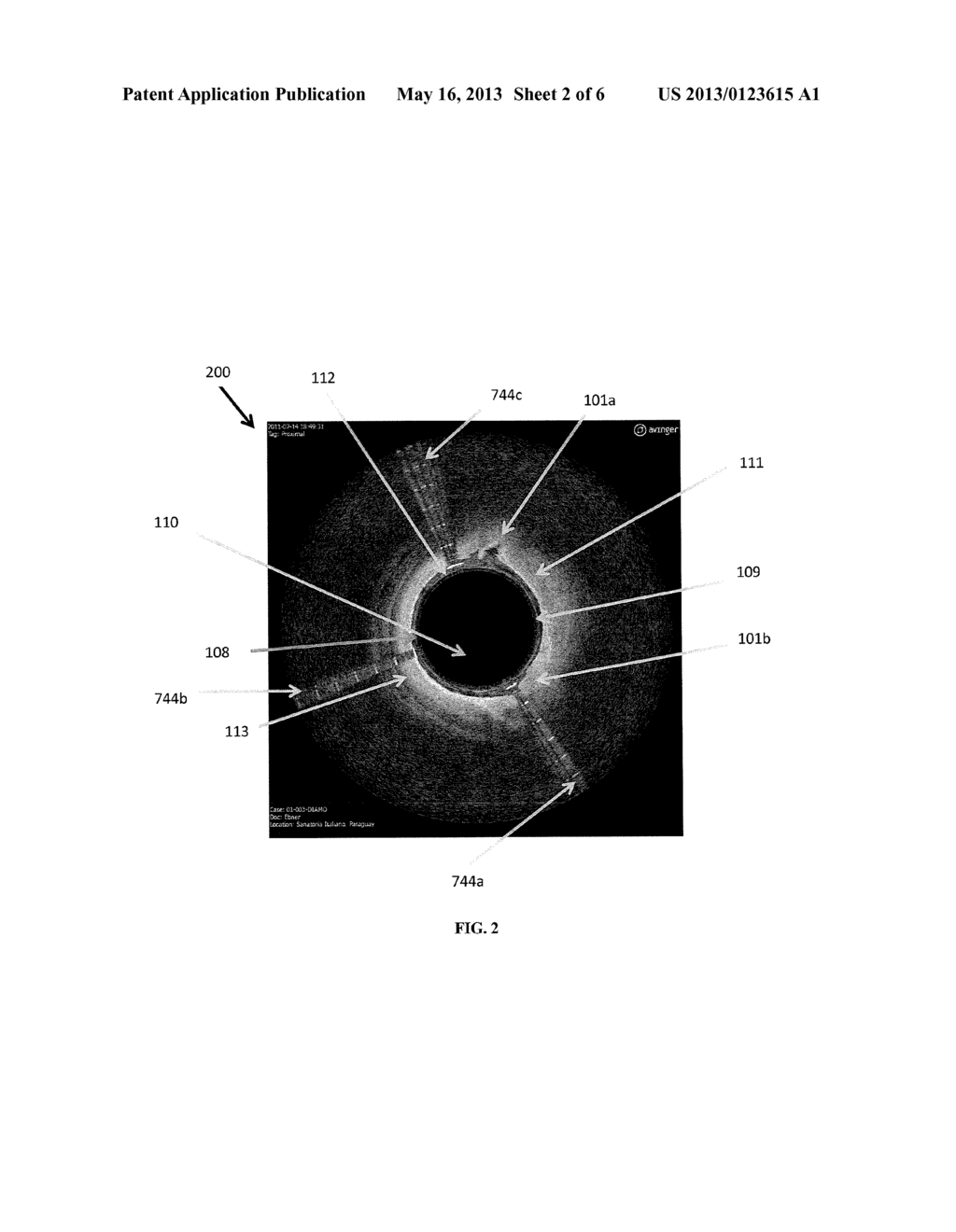 OCCLUSION-CROSSING DEVICES, ATHERECTOMY DEVICES, AND IMAGING - diagram, schematic, and image 03