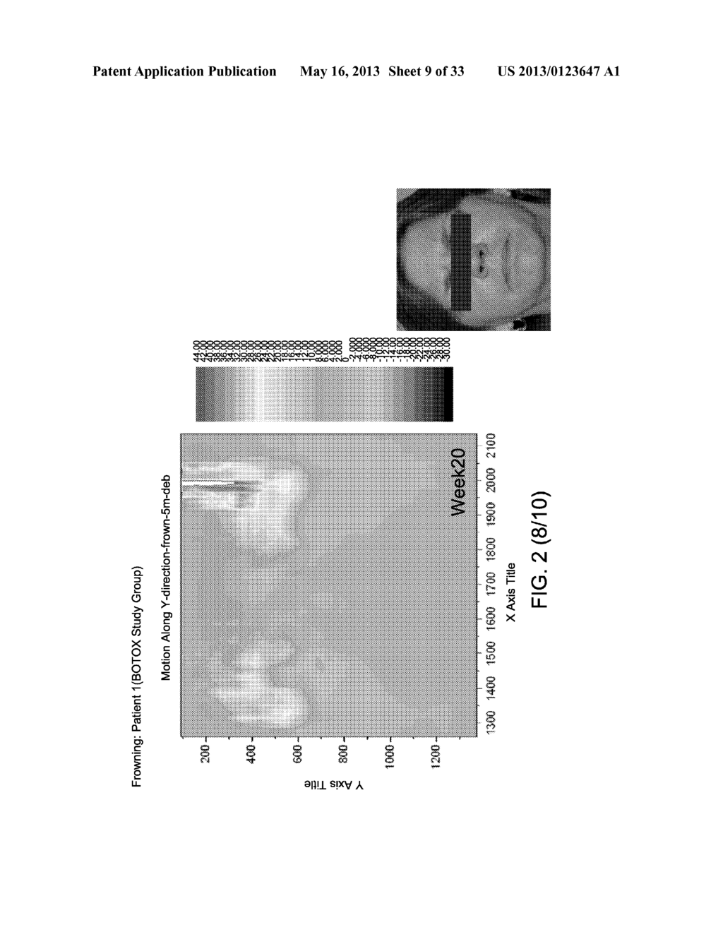 Methods Useful in Optimizing the Treatment of Neuropathies and Targeting     Tissues with Cosmetic Botulinum Injections - diagram, schematic, and image 10