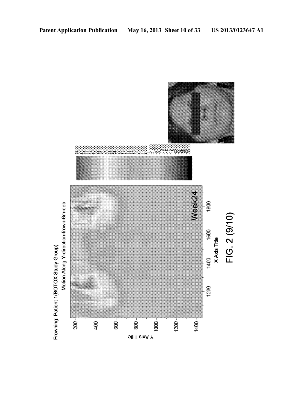 Methods Useful in Optimizing the Treatment of Neuropathies and Targeting     Tissues with Cosmetic Botulinum Injections - diagram, schematic, and image 11