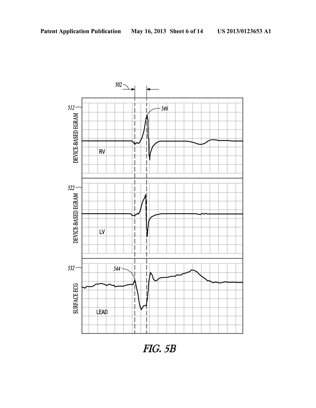 USING DEVICE BASED ELECTROGRAMS TO IDENTIFY BUNDLE BRANCH BLOCK MORPHOLOGY - diagram, schematic, and image 07