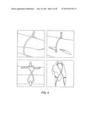 OSTEOSYNTHETIC SHAPE MEMORY MATERIAL INTRAMEDULLARY BONE STENT AND METHOD     FOR TREATING A BONE FRACTURE USING THE SAME diagram and image