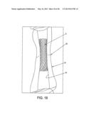 OSTEOSYNTHETIC SHAPE MEMORY MATERIAL INTRAMEDULLARY BONE STENT AND METHOD     FOR TREATING A BONE FRACTURE USING THE SAME diagram and image