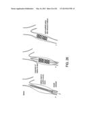 OSTEOSYNTHETIC SHAPE MEMORY MATERIAL INTRAMEDULLARY BONE STENT AND METHOD     FOR TREATING A BONE FRACTURE USING THE SAME diagram and image