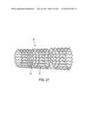 OSTEOSYNTHETIC SHAPE MEMORY MATERIAL INTRAMEDULLARY BONE STENT AND METHOD     FOR TREATING A BONE FRACTURE USING THE SAME diagram and image