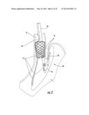 MEDICAL DEVICE FIXATION TOOL AND METHOD OF FIXATION OF A MEDICAL DEVICE diagram and image