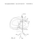 Soft Tissue Repair Device and Associated Methods diagram and image