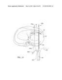 Soft Tissue Repair Device and Associated Methods diagram and image