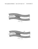 CATHETER INCLUDING CUTTING ELEMENT AND ENERGY EMITTING ELEMENT diagram and image