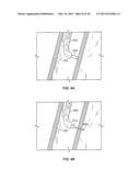 DEVICES FOR MAINTAINING PATENCY OF SURGICALLY CREATED CHANNELS IN TISSUE diagram and image