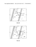 DEVICES FOR MAINTAINING PATENCY OF SURGICALLY CREATED CHANNELS IN TISSUE diagram and image