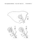 TEMPORARY CATHETER FOR BIOPSY SITE TISSUE FIXATION diagram and image