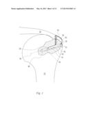 METHOD OF ANCHORING A SUTURE diagram and image