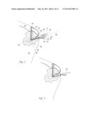 METHOD OF ANCHORING A SUTURE diagram and image