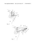 METHOD OF ANCHORING A SUTURE diagram and image