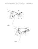 METHOD OF ANCHORING A SUTURE diagram and image