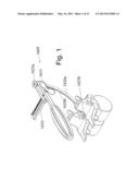 DEVICES AND METHODS FOR THE MINIMALLY INVASIVE TREATMENT OF SPINAL     STENOSIS diagram and image