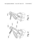 DEVICES AND METHODS FOR THE MINIMALLY INVASIVE TREATMENT OF SPINAL     STENOSIS diagram and image