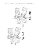 DEVICES AND METHODS FOR THE MINIMALLY INVASIVE TREATMENT OF SPINAL     STENOSIS diagram and image